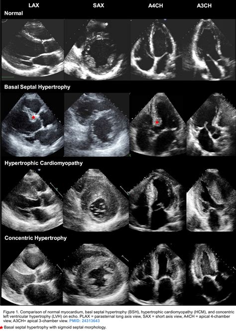 lv hypertrophy|lv hypertrophy on echo.